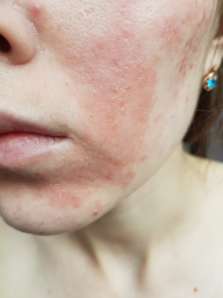 Фото 1. Может ли быть аллергия на плазмолифтинг и как это лечить?