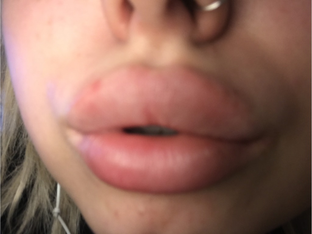 Появление гранул Фордайса на губах после введения филлеров