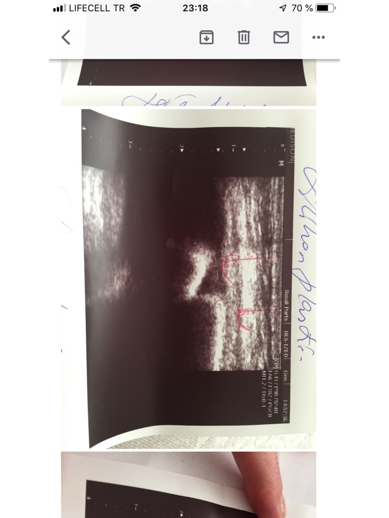 Фото 1. Можно ли заменить разорвавшийся имплант по гарантии от производителя?