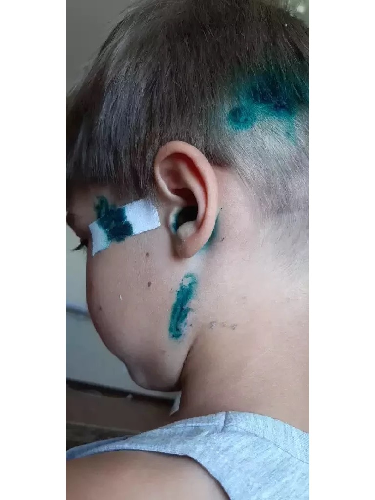 Фото 3. Какие мази можно использовать, чтобы предотвратить образование рубцов при заживлении?