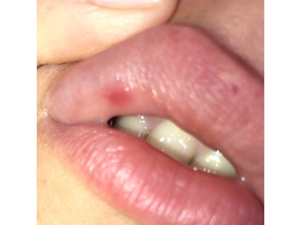 Почему на поверхности губ появляются красные пятна
