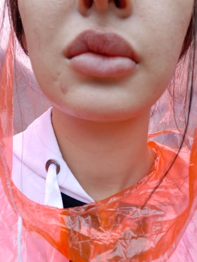Залом на верхней губе после контурной пластики губ