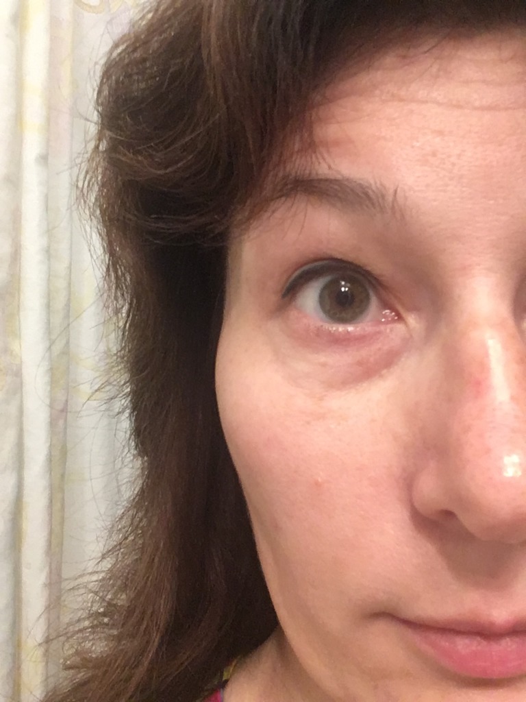 Фото 2. Решит ли проблему блефаропластика?