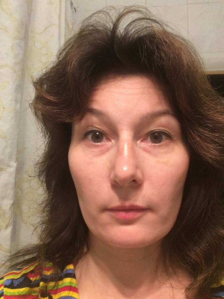 Фото 1. Решит ли проблему блефаропластика?