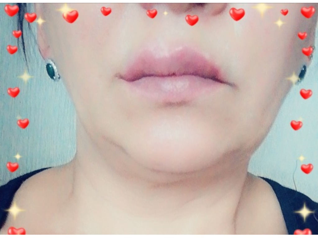 Lip Lift - операция по субназальному поднятию губы