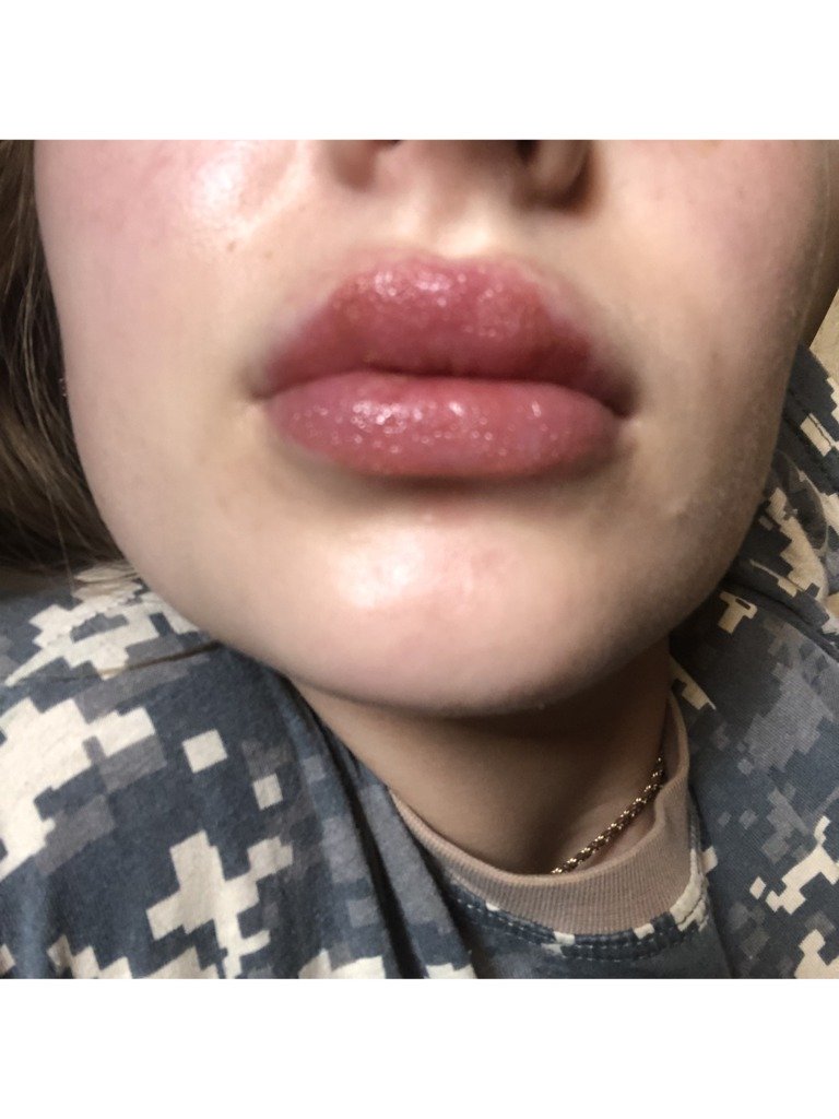 Фото 1. От чего аллергия на губах и почему не проходит?