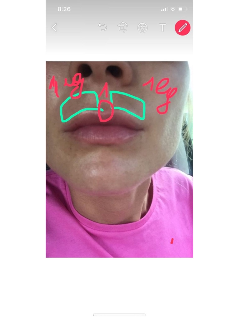 Фото 2. Если аллергия на лонгидазу, то как вывести Ювидерм, вышедший за контуры губ?