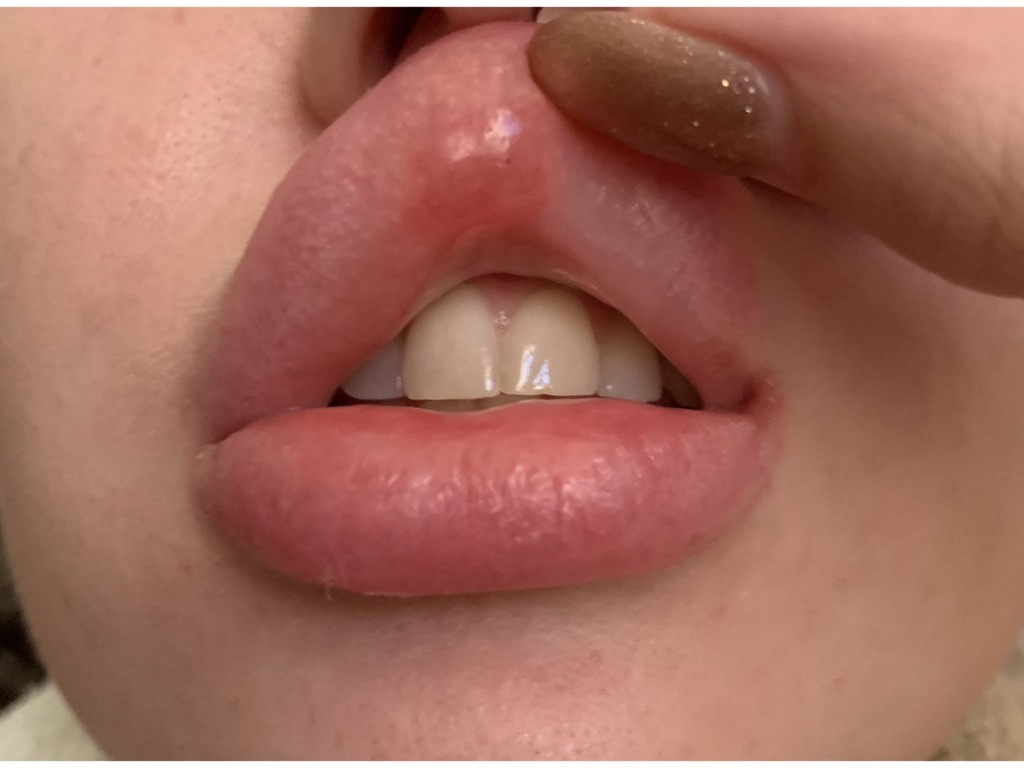 Спустя 2 года после увеличения губ аллергия