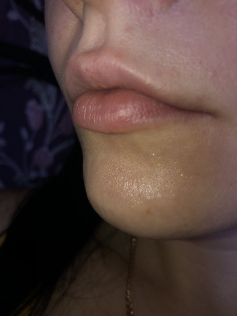 Фото 2. Можно ли увеличивать губы через полгода после коррекции и другим филлером?