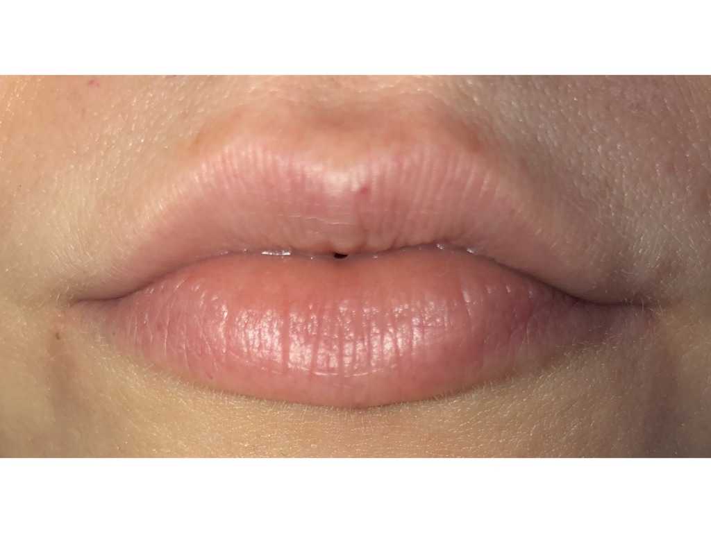 Фото 4. Можно ли увеличивать губы через полгода после коррекции и другим филлером?