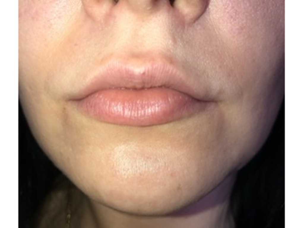 Фото 1. Можно ли увеличивать губы через полгода после коррекции и другим филлером?