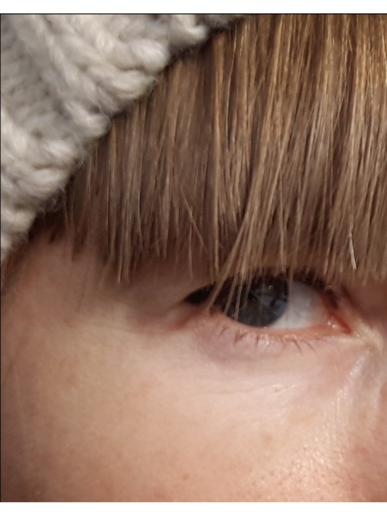 Фото 1. Как восстановить кожу вокруг глаз после биоревитализации?