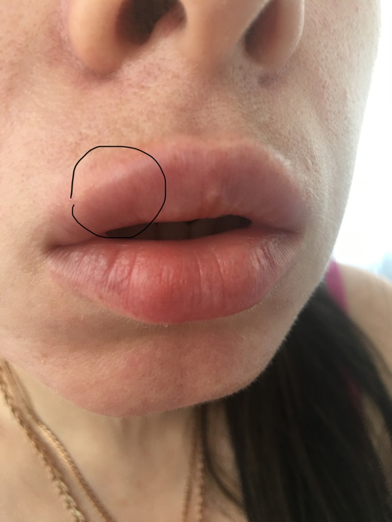 Фото 1. Почему началось жжение в губе через 9 дней после процедуры?