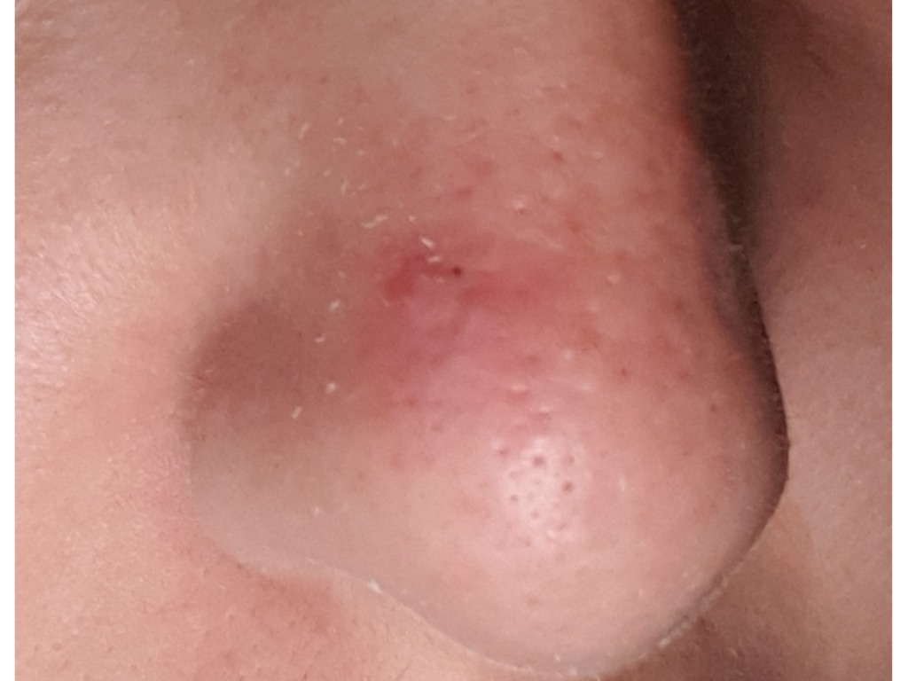 Что это за красное пятно на моем носу?