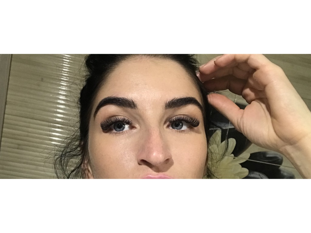 Фото 2. Как убрать колбаски, которые видны после филлера под глазами?