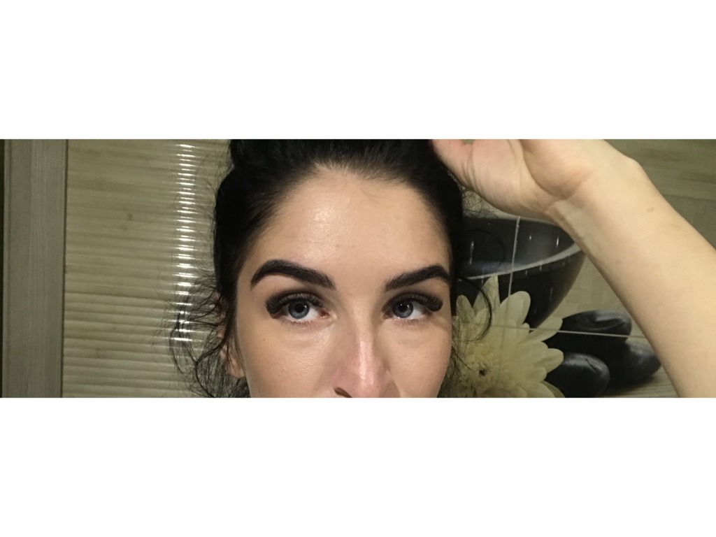 Фото 1. Как убрать колбаски, которые видны после филлера под глазами?