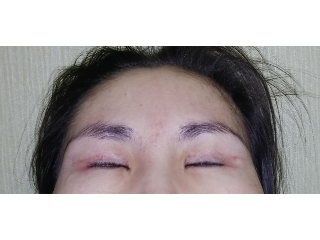 Фото 3. Как устранить несмыкание век после блефаропластики?