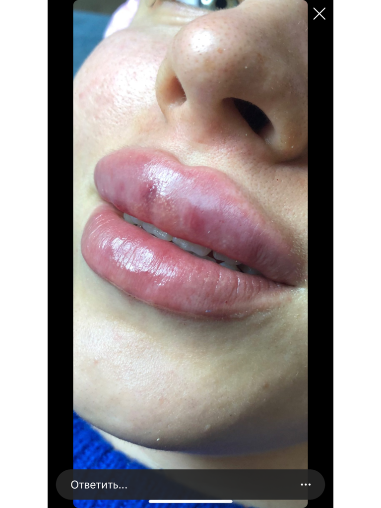Фото 1. Отек после увеличения губ это реакция на прокол или анестезию?