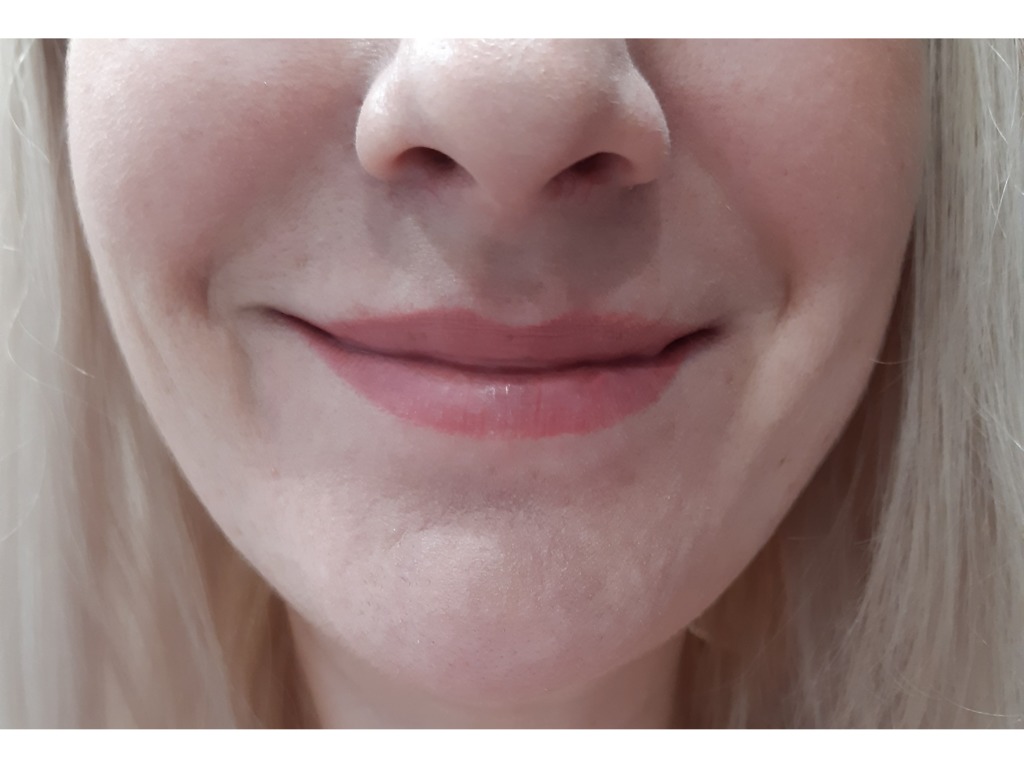 Фото 1. Почему немеет лицо с одной стороны после коррекции носогубок?