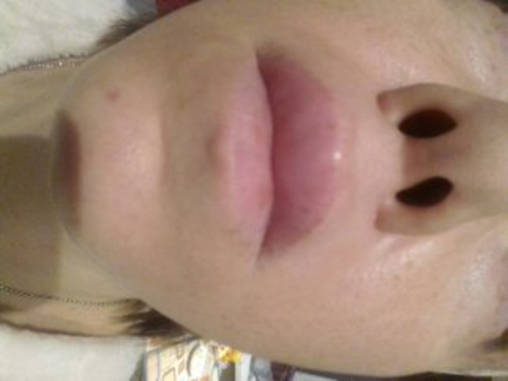 Фото 1. Почему отекли губы спустя год после Ювидерма?