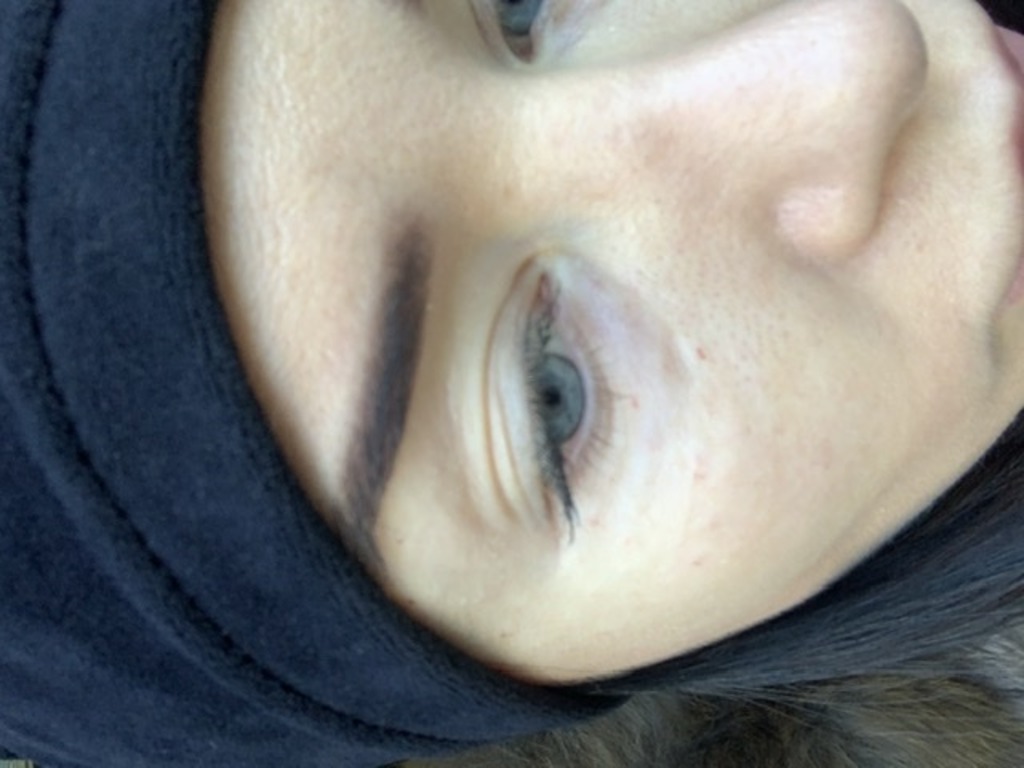 Фото 1. Как убрать филлер из носослезной борозды?