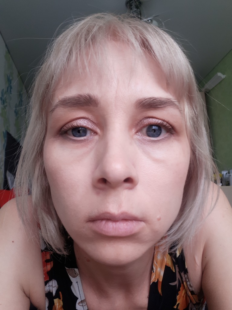 Фото 1. Болит носослезная борозда в течении 11 месяцев после процедуры Perfecta derm, что предпринять?