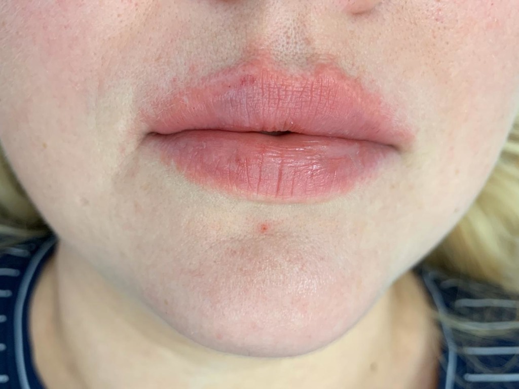 Фото 2. Подскажите, что можно сделать, если не проходит отек после увеличения губ?