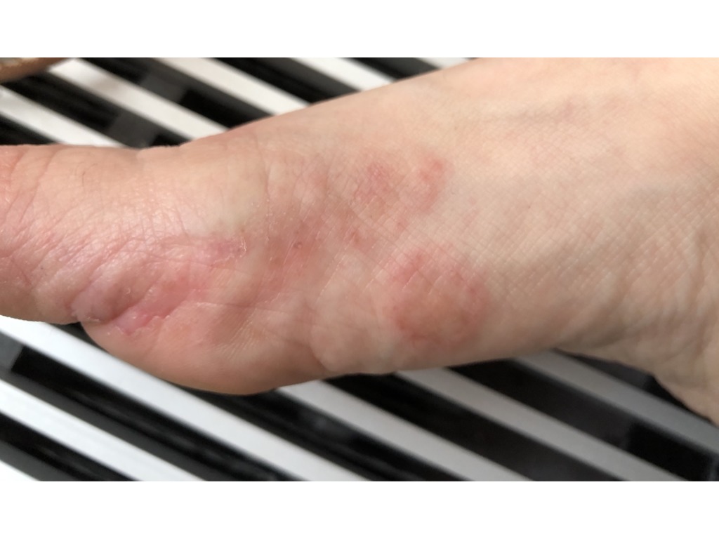 Фото 1. Подскажите, что за болезнь у меня и как ее лечить?