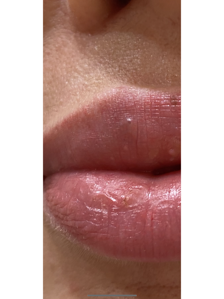 Фото 1. Почему на губах образовались точки наполненные жидкостью?