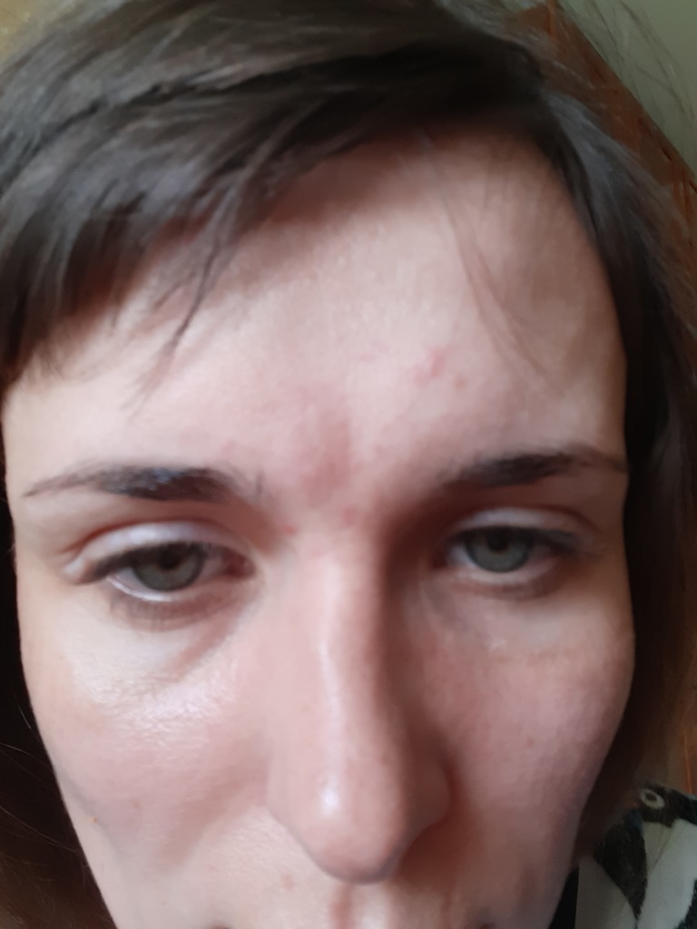 Фото 2. Уйдет ли краснота в межбровье после филлера?