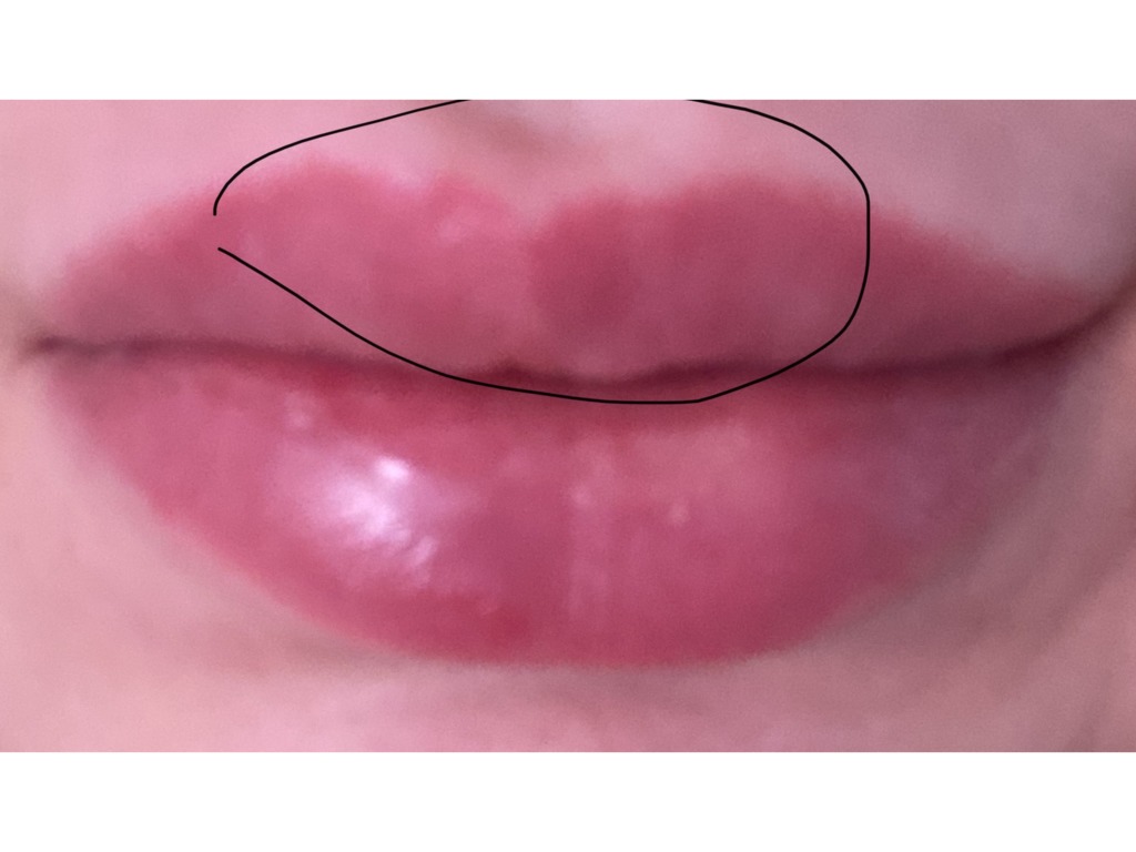 Фото 1. Как исправить ситуацию спустя месяц после увеличения губ?