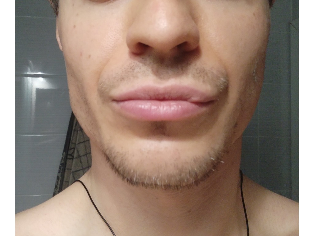 Фото 2. Можно ли вернуть ровный контур губ?