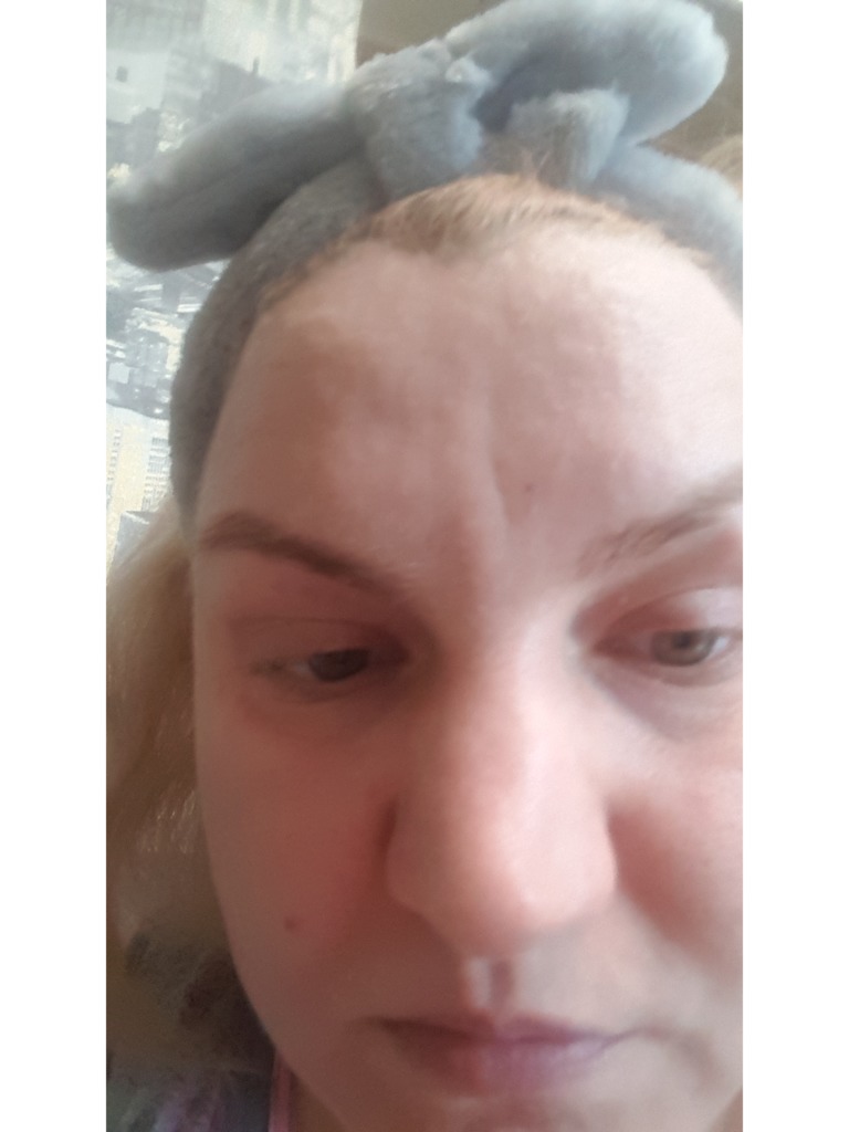 Фото 2. Как убрать межбровный залом