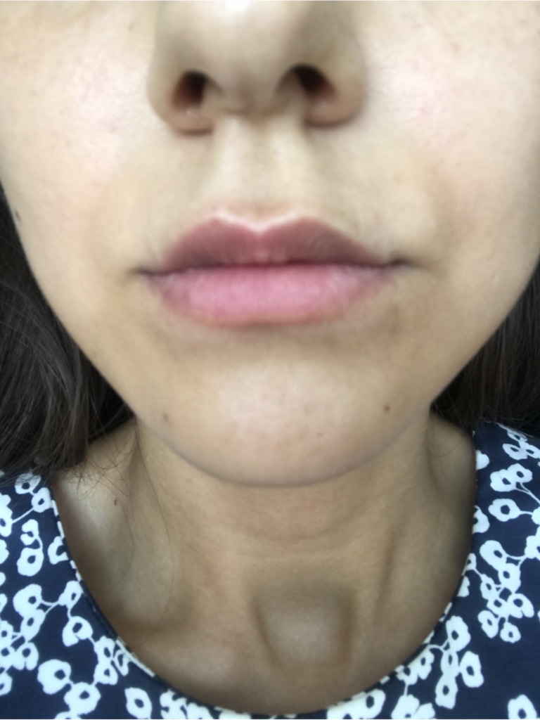 Фото 1. Восстановится ли кожа губ после введения лидазы?