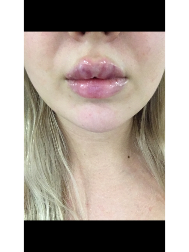 Фото 1. Что делать, если на лонгидазу аллергия, а губы стали гормошкой?