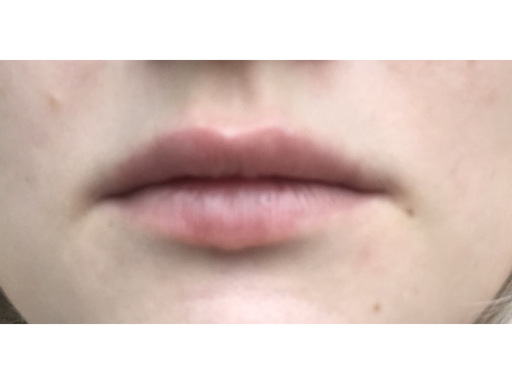 Фото 2. Правильно ли введен филлер, если ощущается валик над губой?