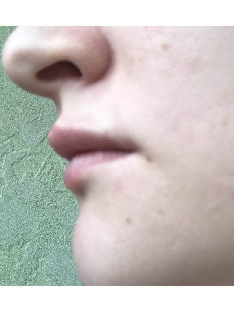 Фото 5. Правильно ли введен филлер, если ощущается валик над губой?