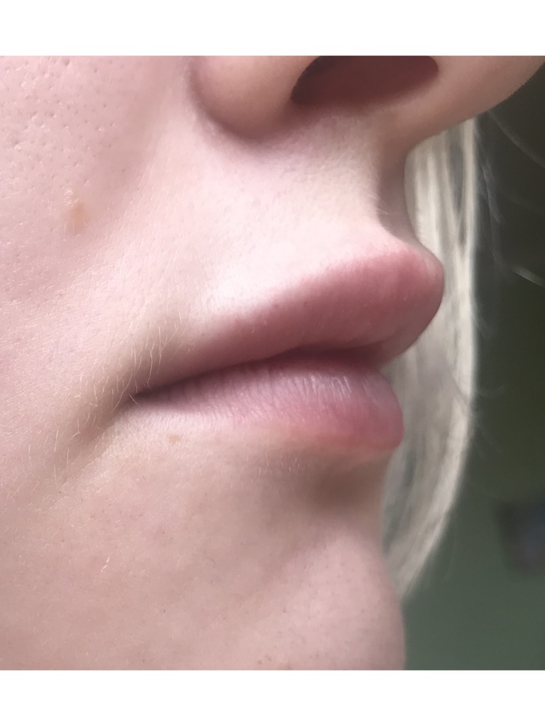 Фото 4. Правильно ли введен филлер, если ощущается валик над губой?