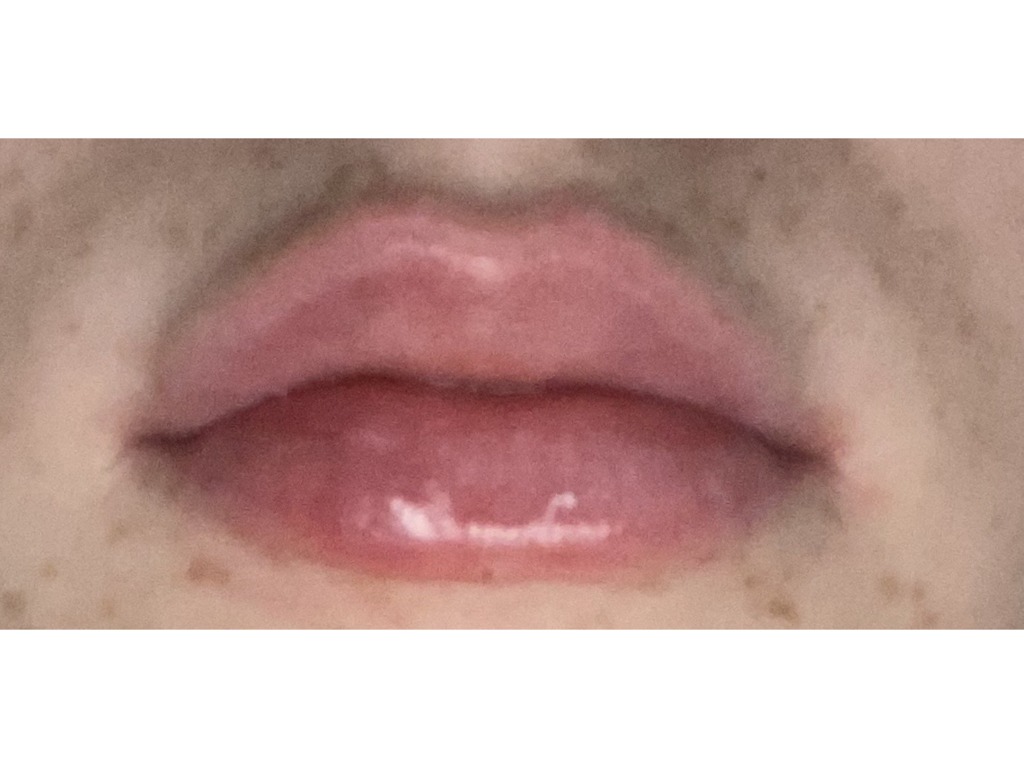 Фото 1. Может ли мигрировать гиалуроновая кислота в губах?