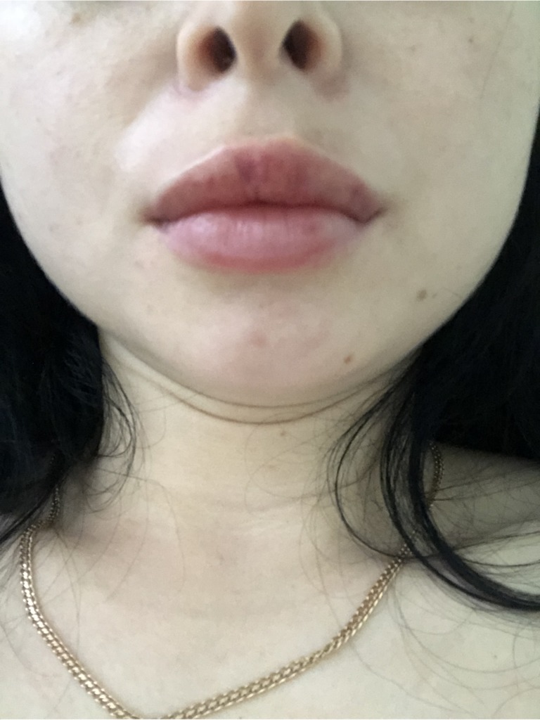 Фото 1. Должен ли косметолог откорректировать губу бесплатно?