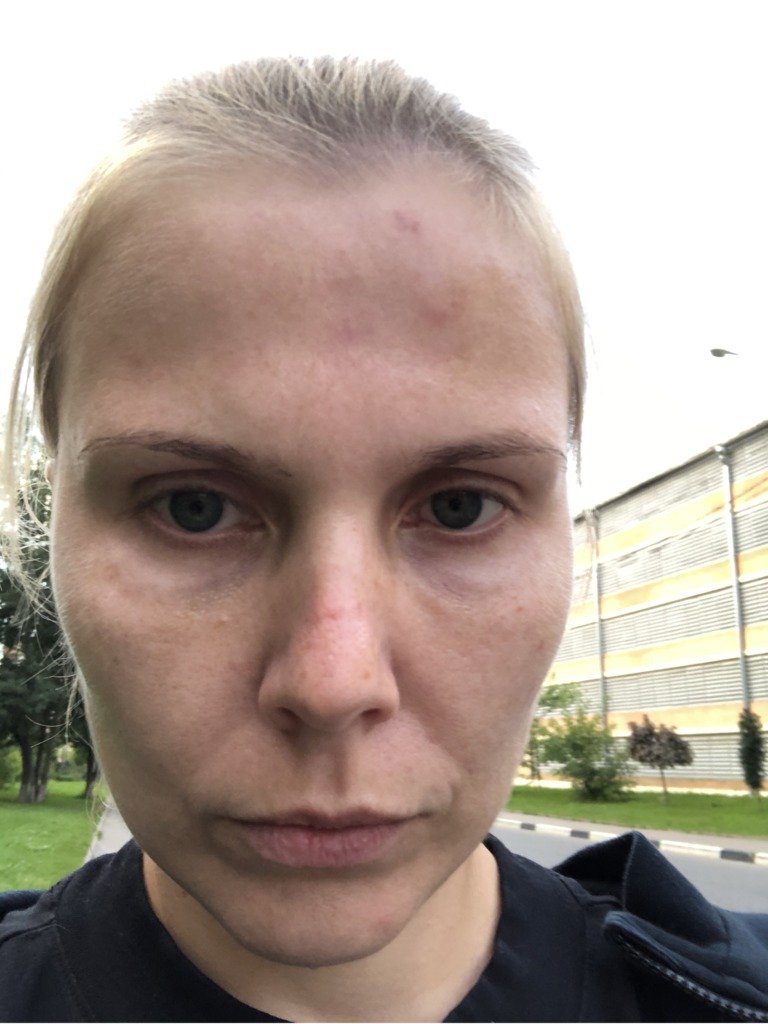 Фото 1. Вернется ли первоначальный вид после выведения филлера гиалуронидазой?