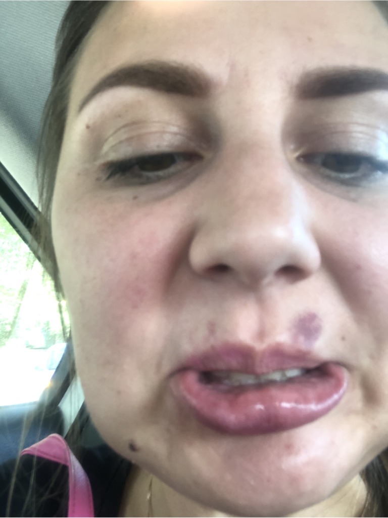 Фото 3. Такой шарик в губе рассосется сам или нет?