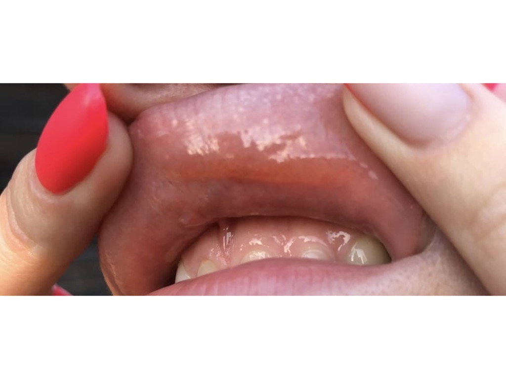 Фото 2. Что делать с этим на губе и куда обратиться?