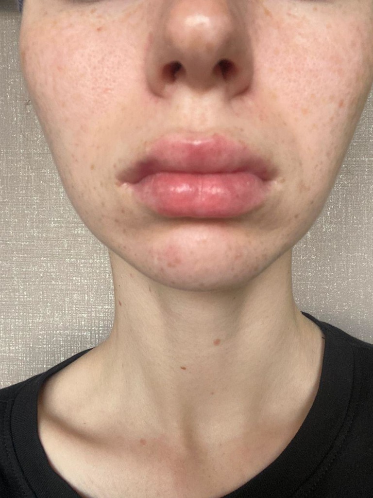 Фото 1. Из-за чего ассиметрия губ после процедуры?