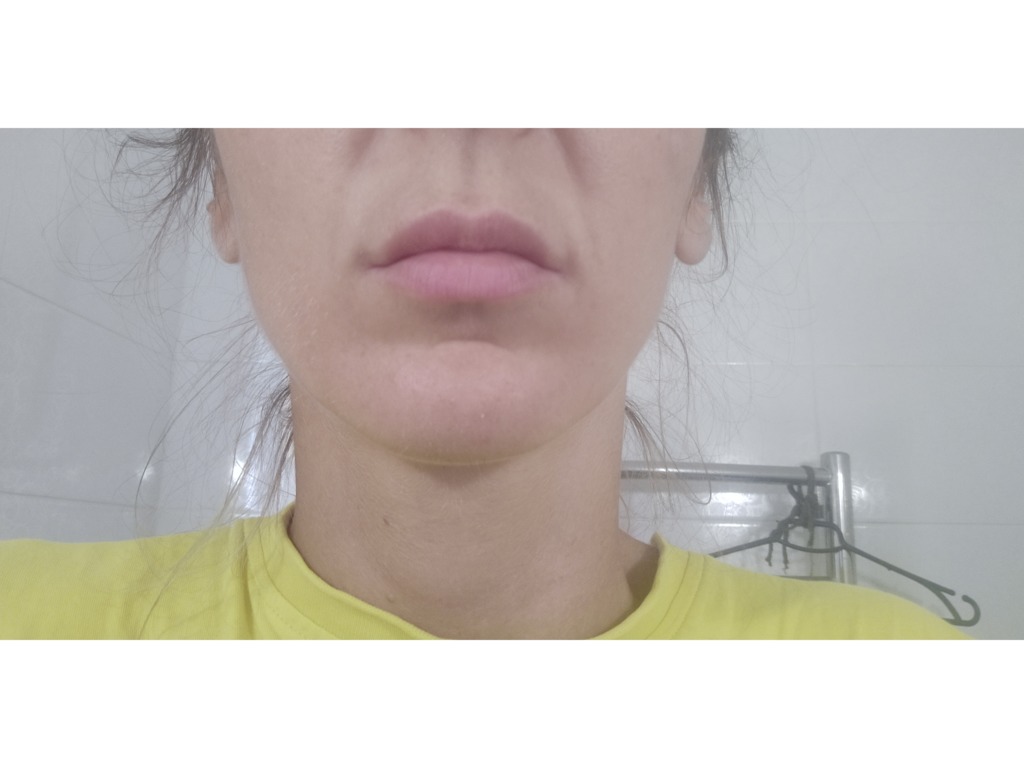 Фото 1. Можно ли делать гиалуроновую кислоту в губы после липофилинга?