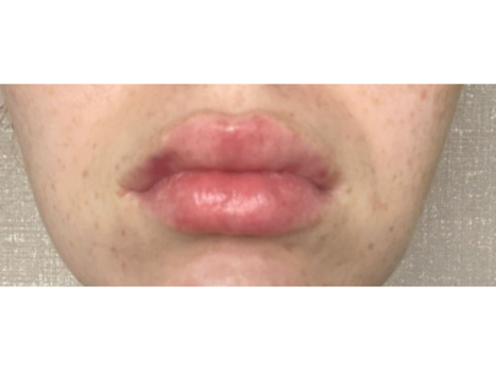 Фото 2. Из-за чего ассиметрия губ после процедуры?