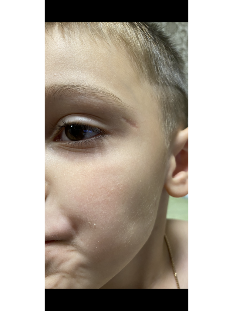 Фото 2. Можно ли скорректировать рубчик на лице у ребёнка?