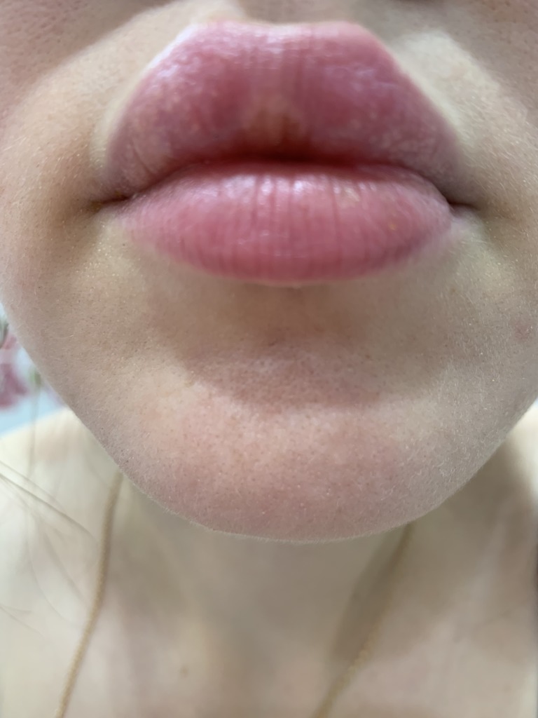Фото 2. Должны ли оставаться уплотнения в губах после увеличения?