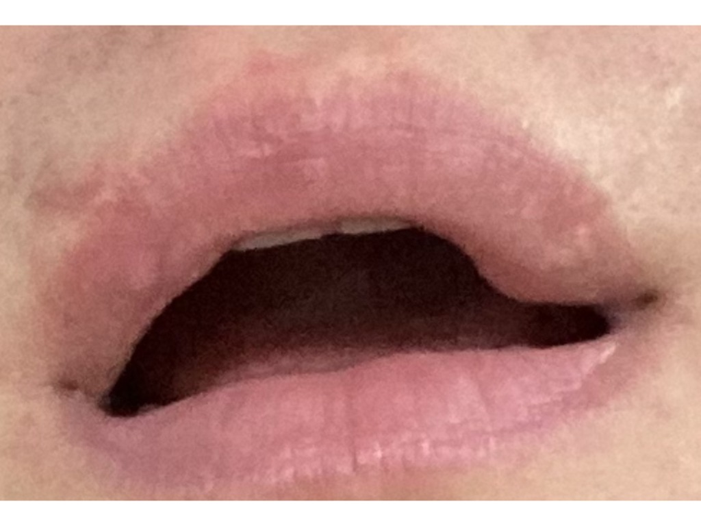 Фото 1. Поможет ли хейлопластика убрать ассиметрию губ после зажившей травмы?