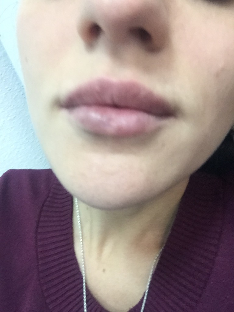 Фото 1. Что делать если губы жгут и немеют?